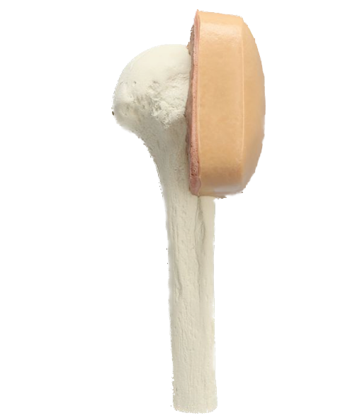 Humerus with skin patch, EA